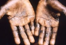 Two monkeypox patients recover from disease: health ministry Mpox - The News Today - TNT