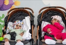 Turkish Doctors Separate Conjoined Pakistani Twins After 14-Hour Surgery Girls - The News Today - TNT