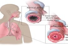 Toxic Brew In Air Full Of Metals, Sulphats Linked Of Rising Asthma Asthma - The News Today - TNT