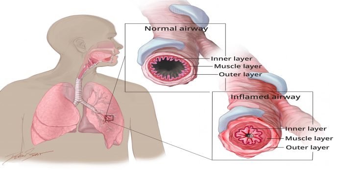 Asthma Asthma - The News Today - TNT